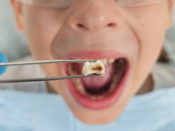 Best Chipped Tooth Repair Near Me  in Colfax, WA